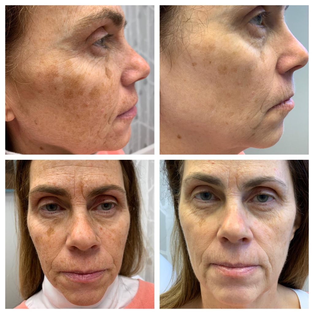 results of Vi Peel treatment on face skin